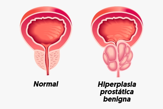hiperplasia prostática benigna