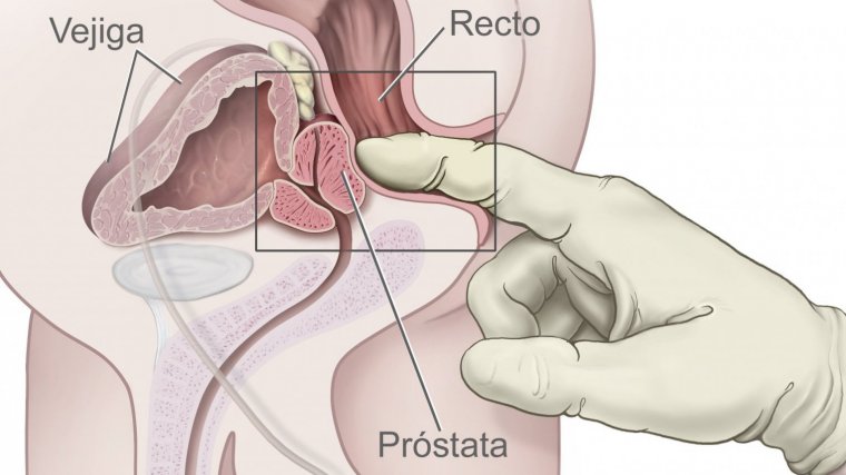prostatitis hiperplasia prostática benigna