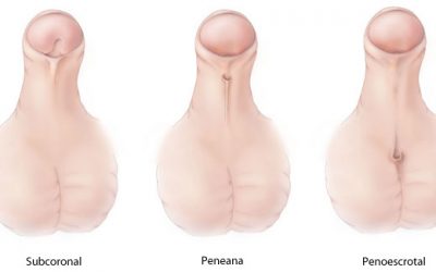 Anomalías del pene y de la uretra
