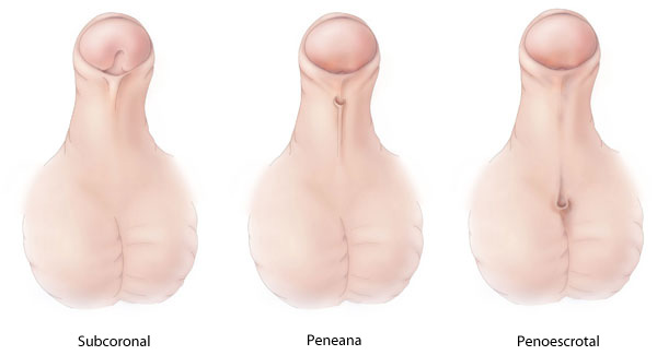 spanish_Hypospadias-lg Anomalías del pene y de la uretra